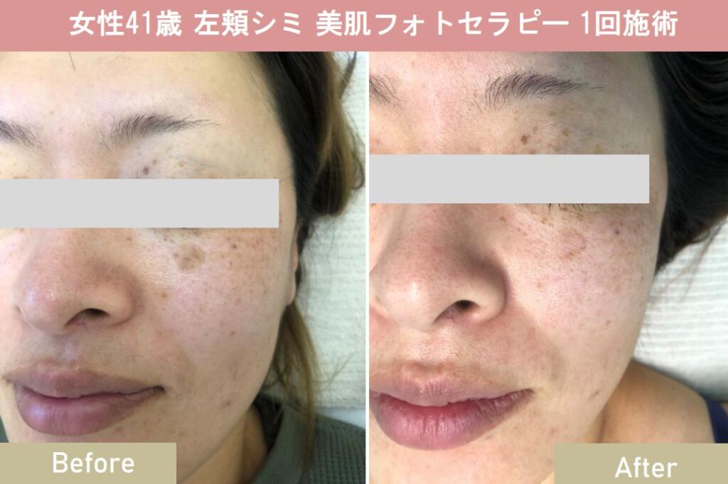 フォトフェイシャルで美肌効果を！おすすめの効果的な施術方法とは 